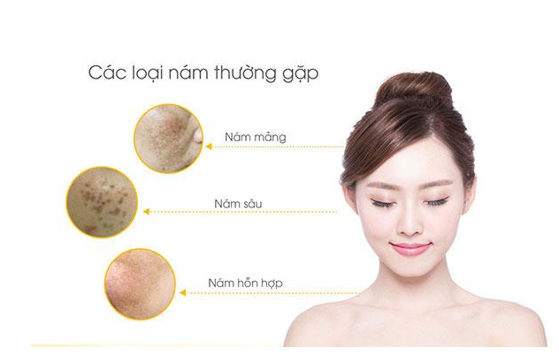 Xông hơi trị nám